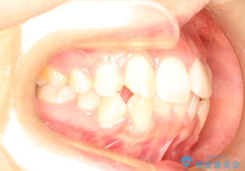 前歯が1本内側に引っ込んでいる　ワイヤーによる抜歯矯正の治療前