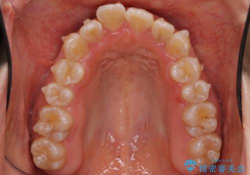 上下の前歯のがたつき　歯を抜かずに矯正の治療中