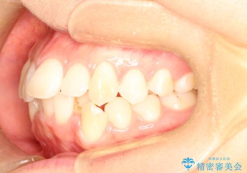 前歯が1本内側に引っ込んでいる ワイヤーによる抜歯矯正の治療前