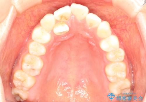 前歯が1本内側に引っ込んでいる ワイヤーによる抜歯矯正の治療前