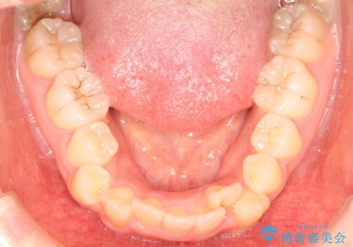 前歯が1本内側に引っ込んでいる ワイヤーによる抜歯矯正の治療前