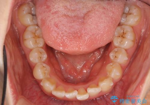 上下の前歯のがたつき 歯を抜かずに矯正の治療中
