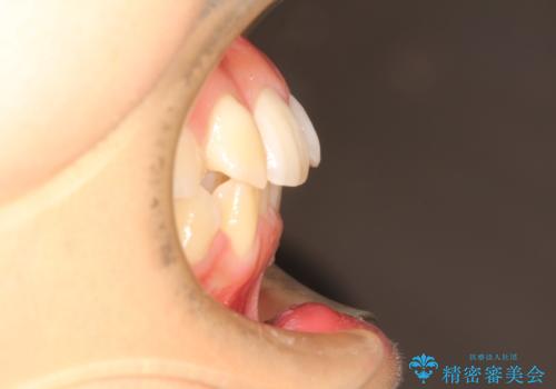 前歯が1本内側に引っ込んでいる　ワイヤーによる抜歯矯正の治療前