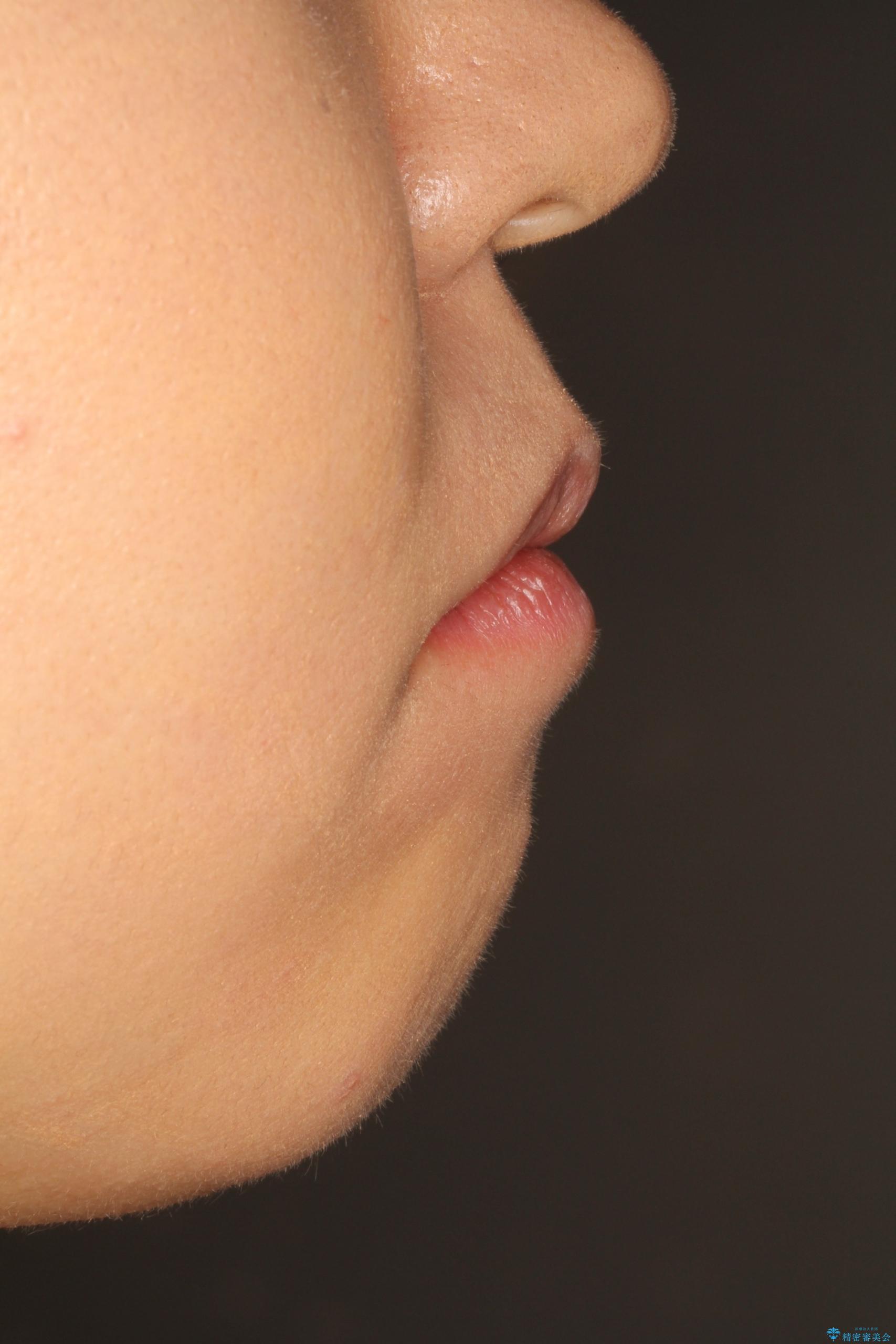 前歯が1本内側に引っ込んでいる ワイヤーによる抜歯矯正の治療前(顔貌)