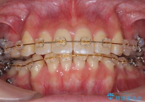 再矯正 一度抜かないでやったが、やっぱり抜いて口元下げたいの治療中