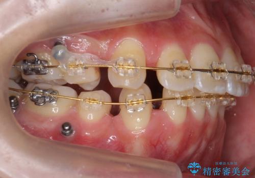 再矯正 一度抜かないでやったが、やっぱり抜いて口元下げたいの治療中