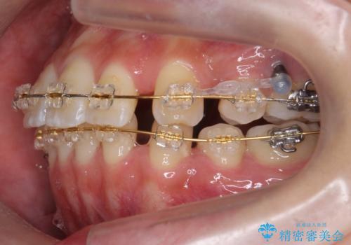 再矯正 一度抜かないでやったが、やっぱり抜いて口元下げたいの治療中