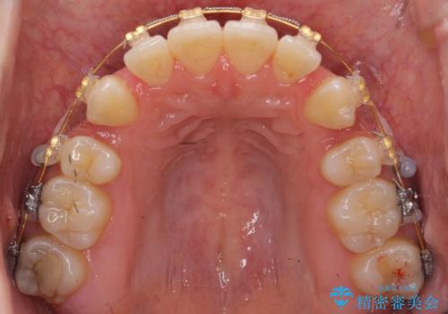再矯正 一度抜かないでやったが、やっぱり抜いて口元下げたいの治療中