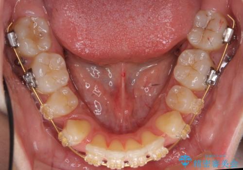 再矯正 一度抜かないでやったが、やっぱり抜いて口元下げたいの治療中