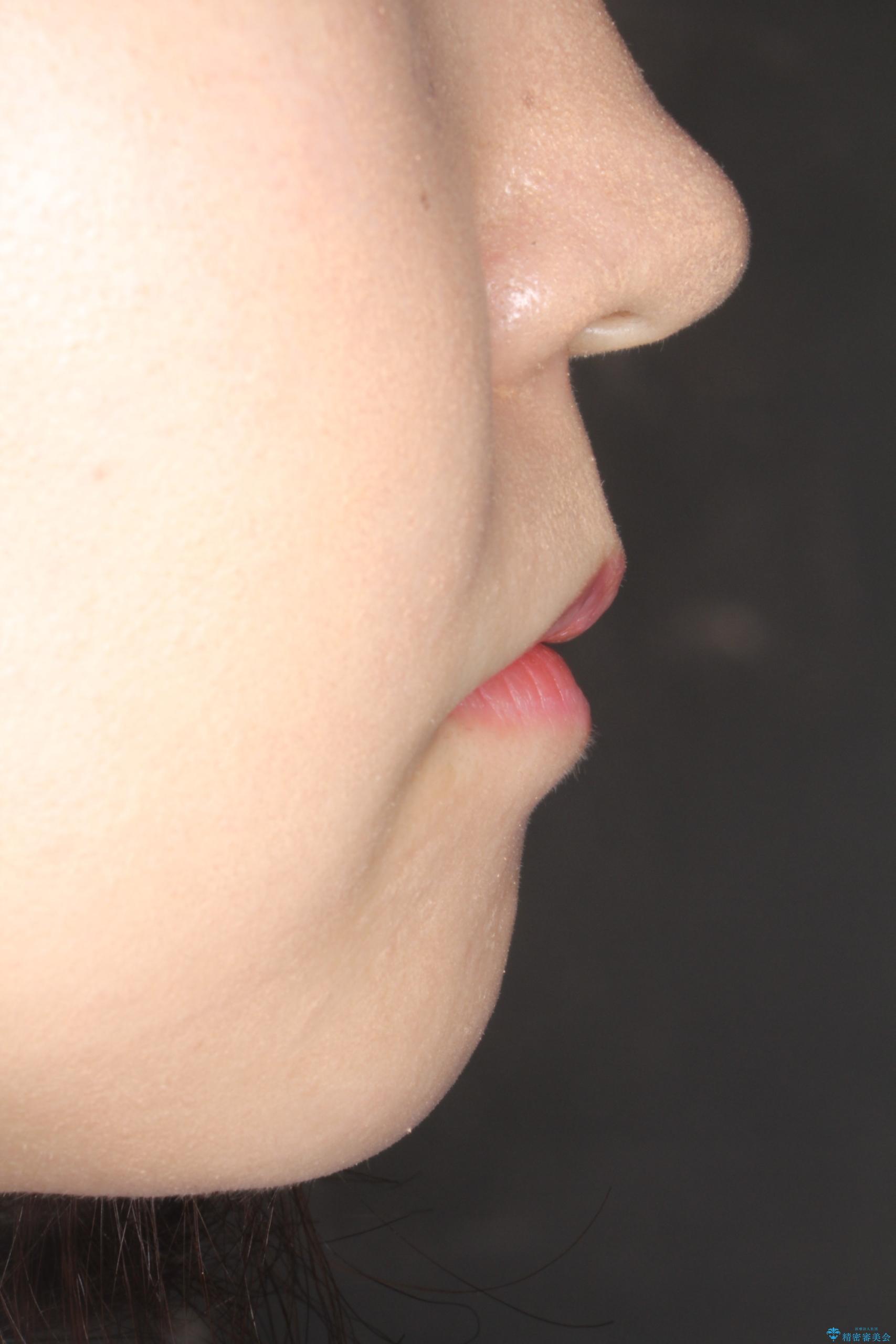 前歯が1本内側に引っ込んでいる ワイヤーによる抜歯矯正の治療後(顔貌)