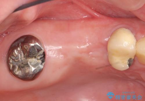 インプラント(ストローマン) 抜歯後の欠損補綴の治療前