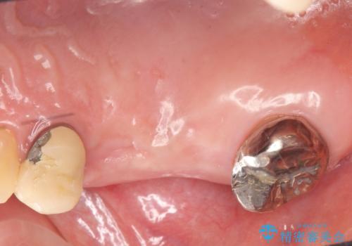 インプラント(ストローマン)　抜歯後の欠損補綴の治療前