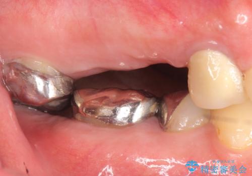 インプラント(ストローマン) 抜歯後の欠損補綴の治療前
