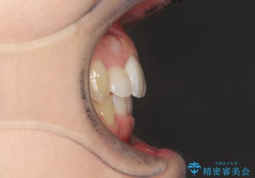 前歯が1本内側に引っ込んでいる ワイヤーによる抜歯矯正の治療後