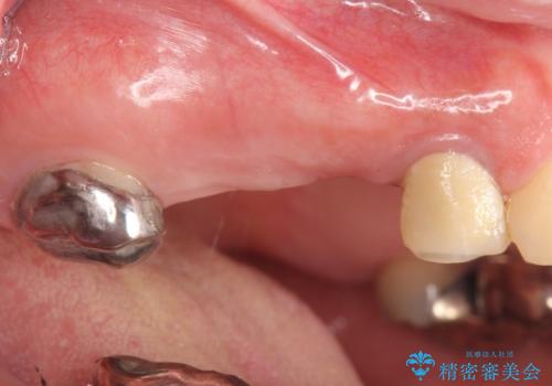 インプラント(ストローマン) 抜歯後の欠損補綴の治療前