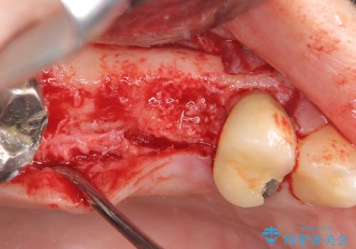 インプラント(ストローマン) 抜歯後の欠損補綴の治療中