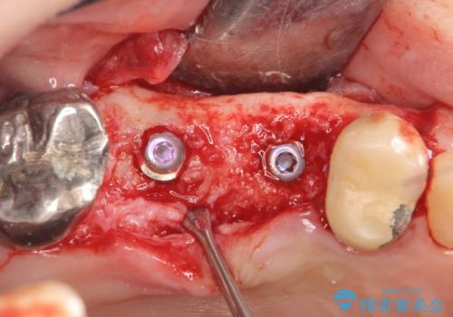 インプラント(ストローマン) 抜歯後の欠損補綴の治療中