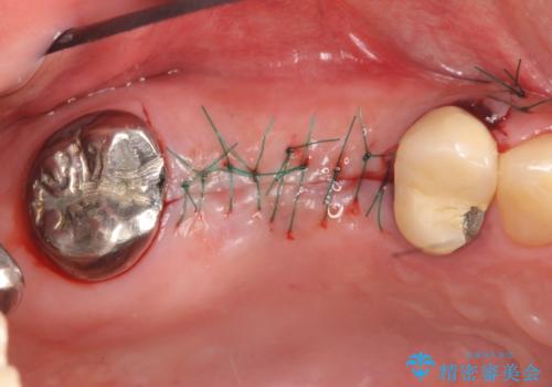 インプラント(ストローマン) 抜歯後の欠損補綴の治療後