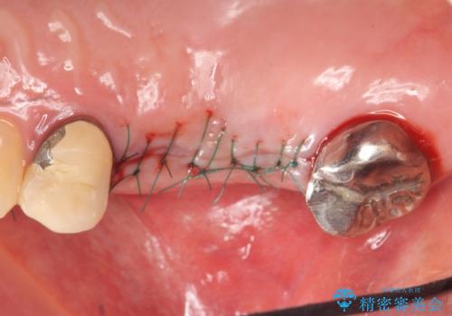 インプラント(ストローマン) 抜歯後の欠損補綴の治療後