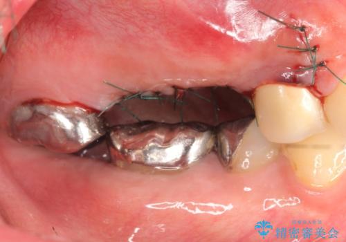 インプラント(ストローマン) 抜歯後の欠損補綴の治療後