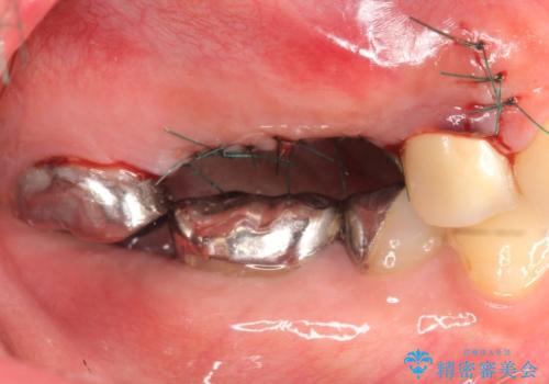 インプラント(ストローマン)　抜歯後の欠損補綴の治療後