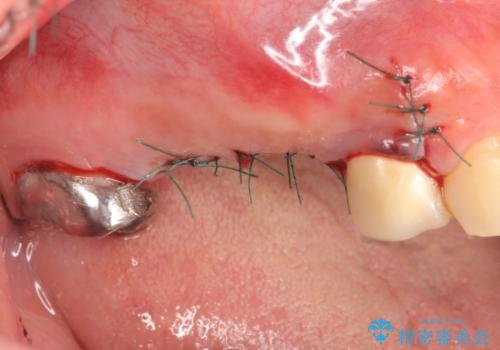 インプラント(ストローマン) 抜歯後の欠損補綴の治療後