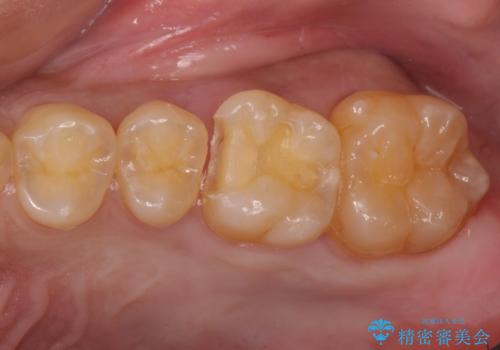奥歯の虫歯 セラミックインレーにの治療中