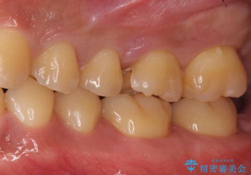 奥歯の虫歯 セラミックインレーにの治療中