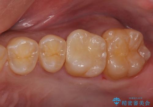 奥歯の虫歯 セラミックインレーにの治療後