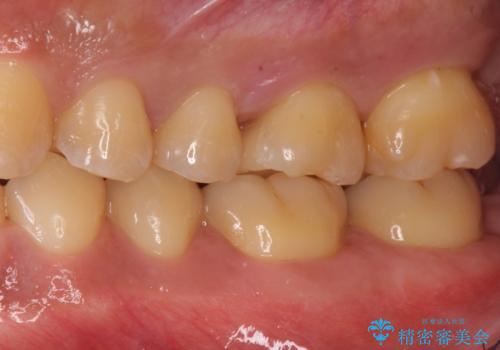 奥歯の虫歯 セラミックインレーにの治療後