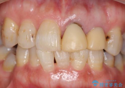 オールセラミッククラウン 前歯のブリッジ 気になる見た目の改善の治療前