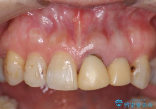 オールセラミッククラウン 前歯のブリッジ 気になる見た目の改善の症例 治療前