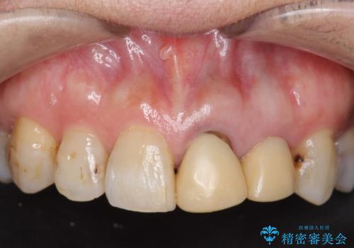オールセラミッククラウン 前歯のブリッジ 気になる見た目の改善の治療前