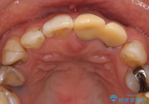 オールセラミッククラウン 前歯のブリッジ 気になる見た目の改善の治療前