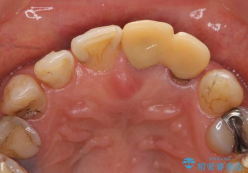 オールセラミッククラウン 前歯のブリッジ 気になる見た目の改善の治療前
