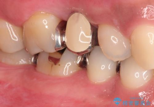 根管治療からのオールセラミックブリッジ装着の治療前