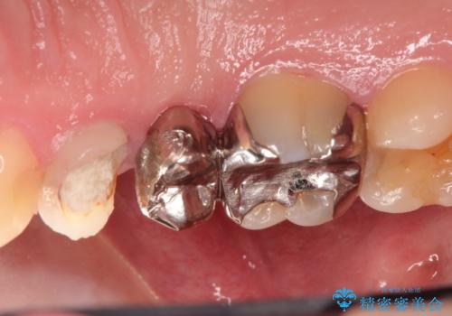 根管治療からのオールセラミックブリッジ装着の治療前