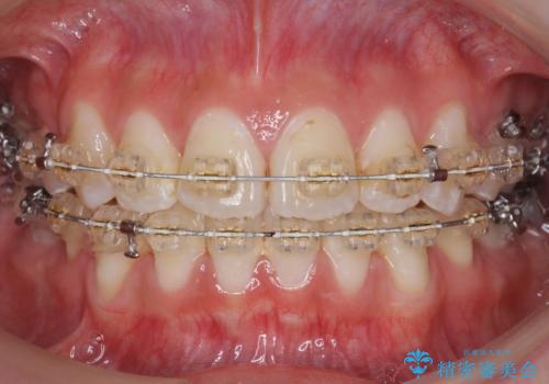 八重歯の治療 仕上がり重視での治療中
