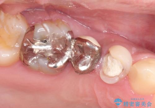根管治療からのオールセラミックブリッジ装着の治療前