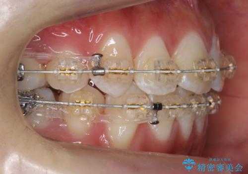 八重歯の治療　仕上がり重視での治療中