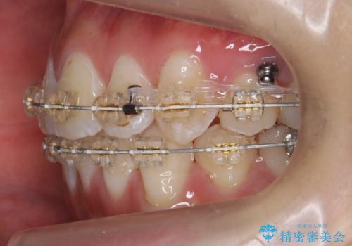 八重歯の治療　仕上がり重視での治療中