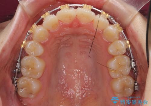八重歯の治療 仕上がり重視での治療中