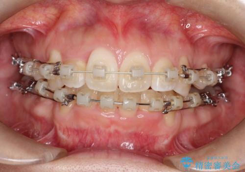 前歯が1本内側に引っ込んでいる　ワイヤーによる抜歯矯正の治療中