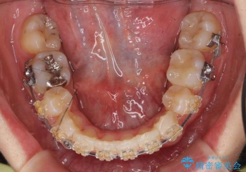 八重歯の治療 仕上がり重視での治療中