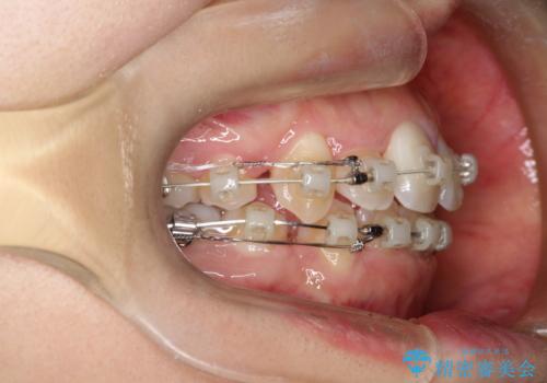 前歯が1本内側に引っ込んでいる ワイヤーによる抜歯矯正の治療中