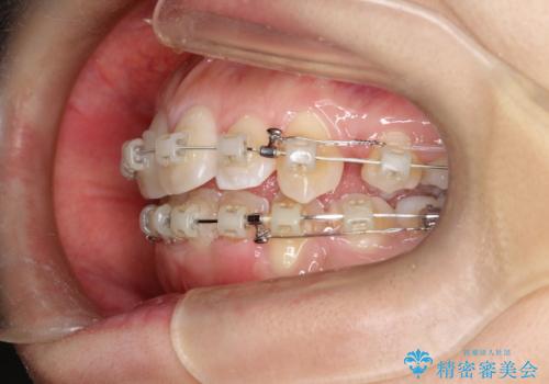 前歯が1本内側に引っ込んでいる ワイヤーによる抜歯矯正の治療中