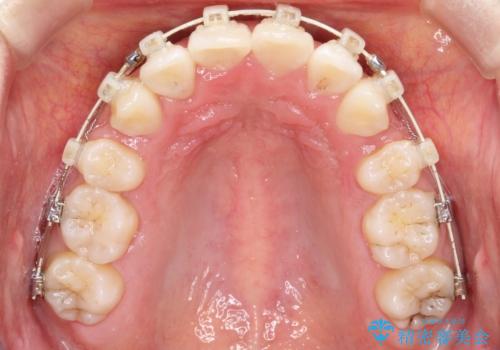 前歯が1本内側に引っ込んでいる ワイヤーによる抜歯矯正の治療中