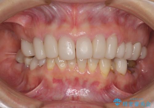 歯の欠損を放置 オールセラミックブリッジによる補綴治療の治療前