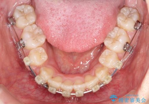 前歯が1本内側に引っ込んでいる　ワイヤーによる抜歯矯正の治療中