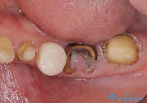 歯の欠損を放置 オールセラミックブリッジによる補綴治療の治療前